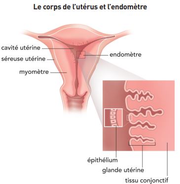 Cancer de l'endomètre ICM