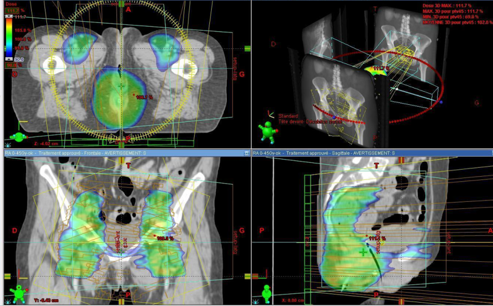 radiothérapie à l'ICM 